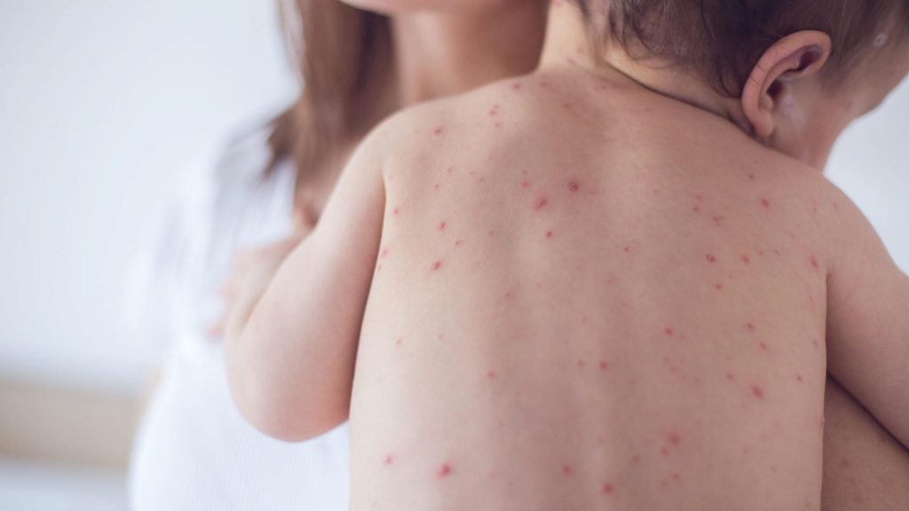 la varicela en niños