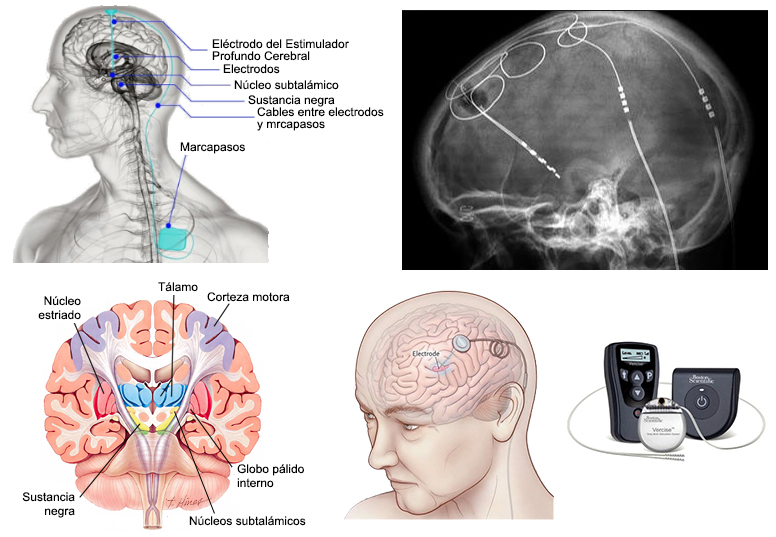 estimulador cerebral profunda